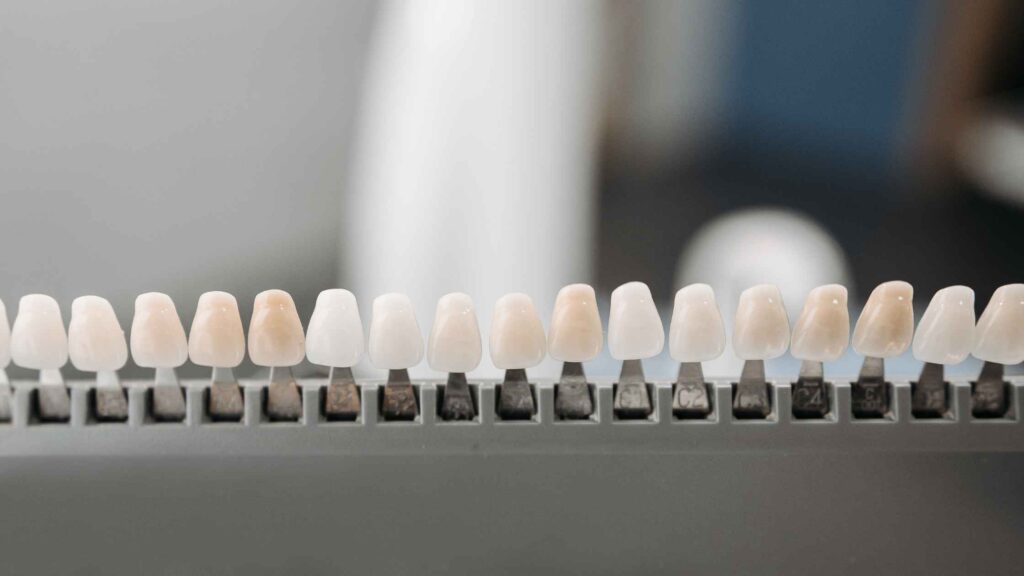 Composite Veneers