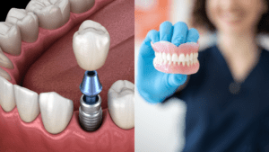 Dentures vs. Implants – Making an Informed Choice