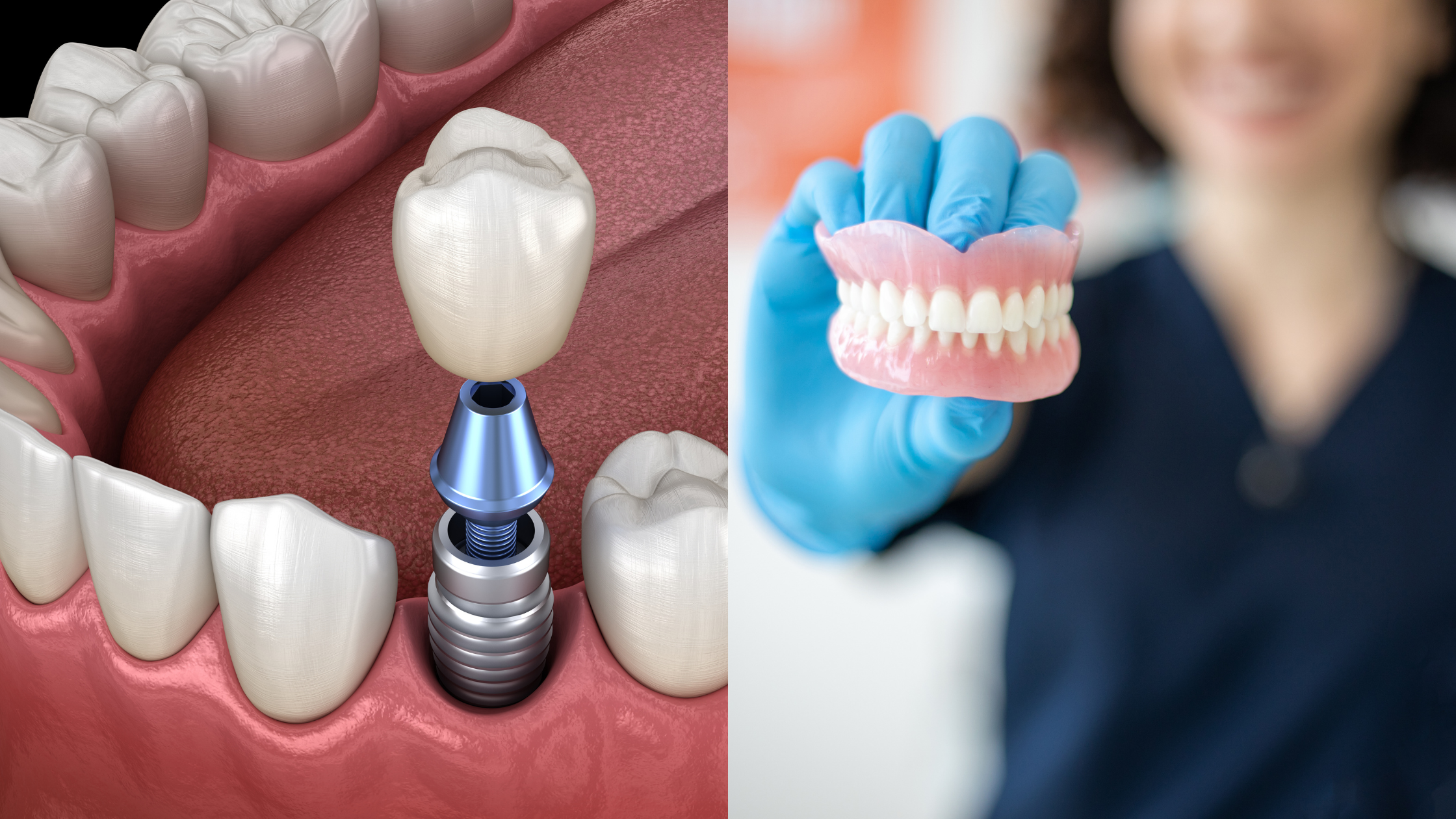 Dentures vs. Implants – Making an Informed Choice