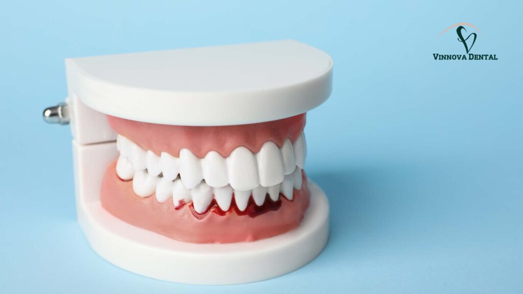 From Bad Breath to Bone Loss: The Real Risks of Gum Disease