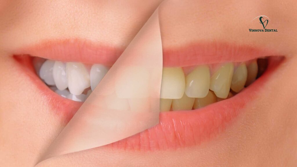 Professional Teeth Whitening in Albury