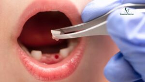 Tooth Extraction