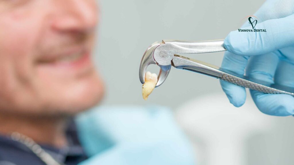 Tooth Extraction