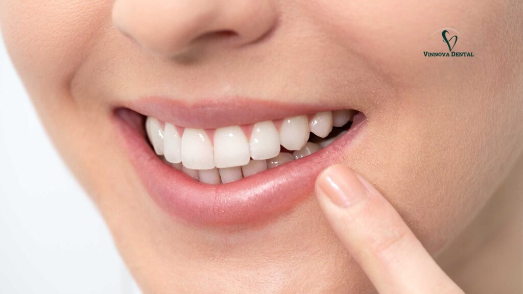 Professional Teeth Whitening 