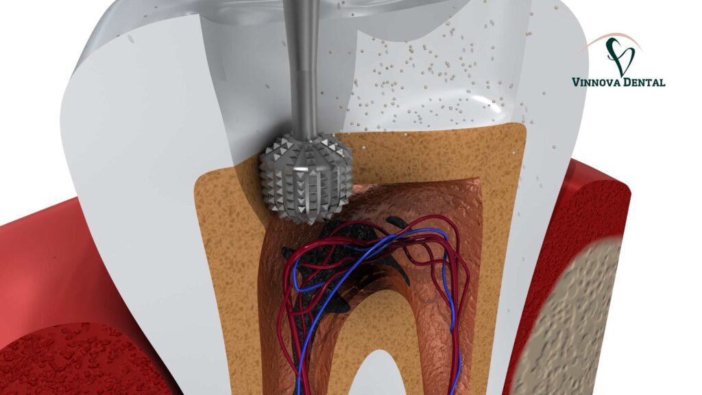 Root Canal Treatment