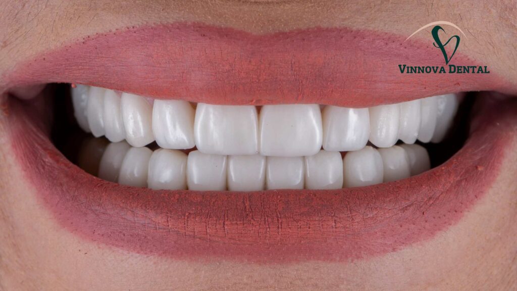 Dental Crown: How It Restores Your Smile and Confidence