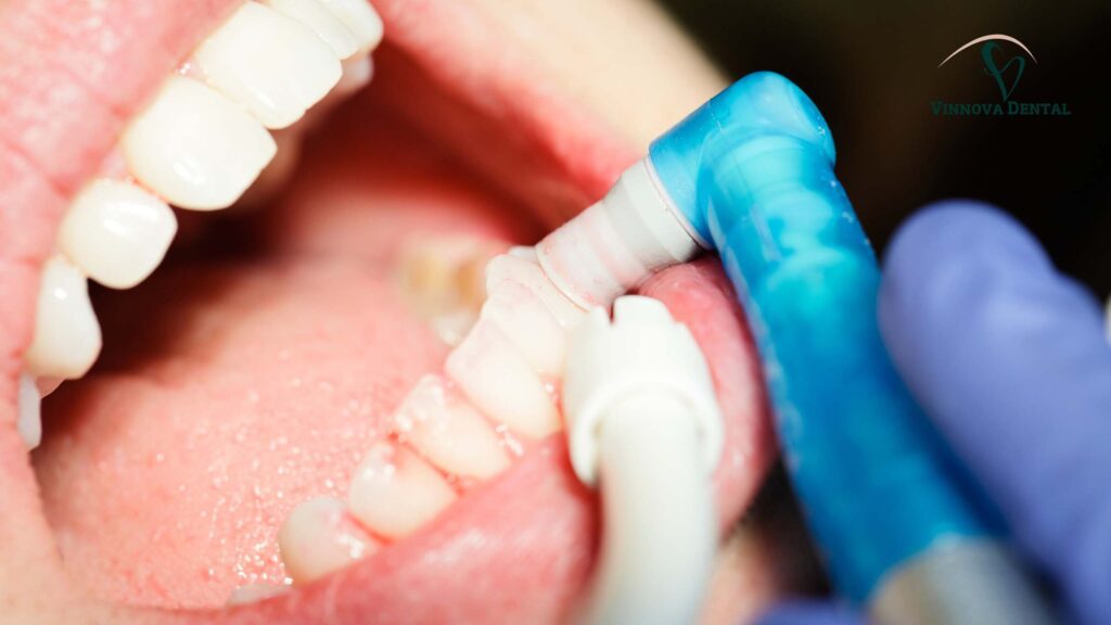 Dental Cleaning and Scaling