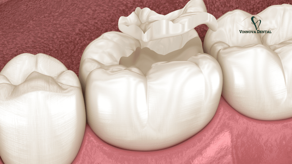 Tooth-Colored Fillings