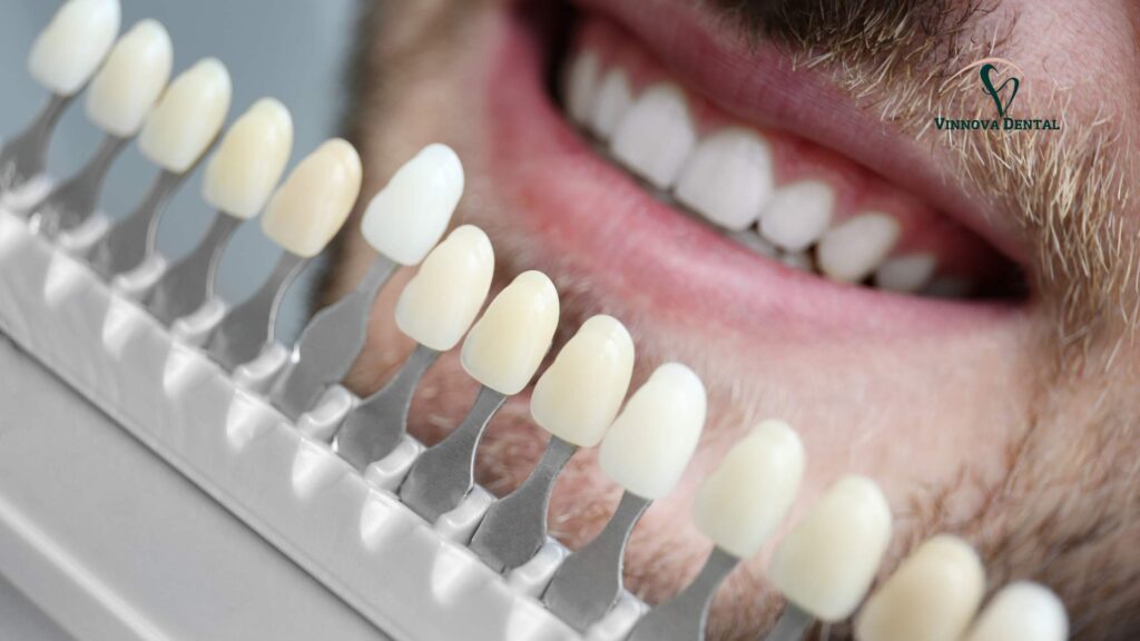 Composite Veneers