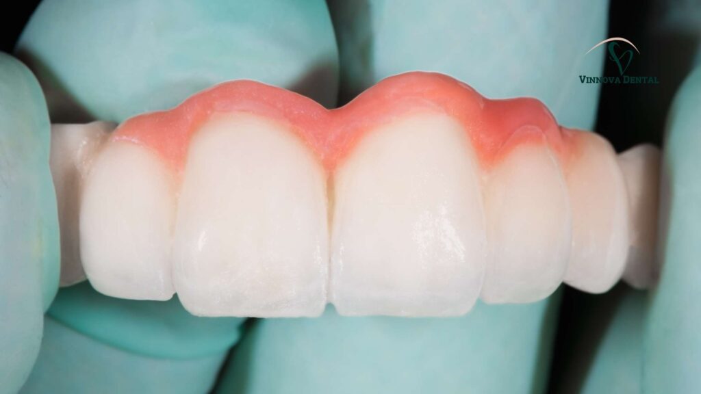 Dental Bridges