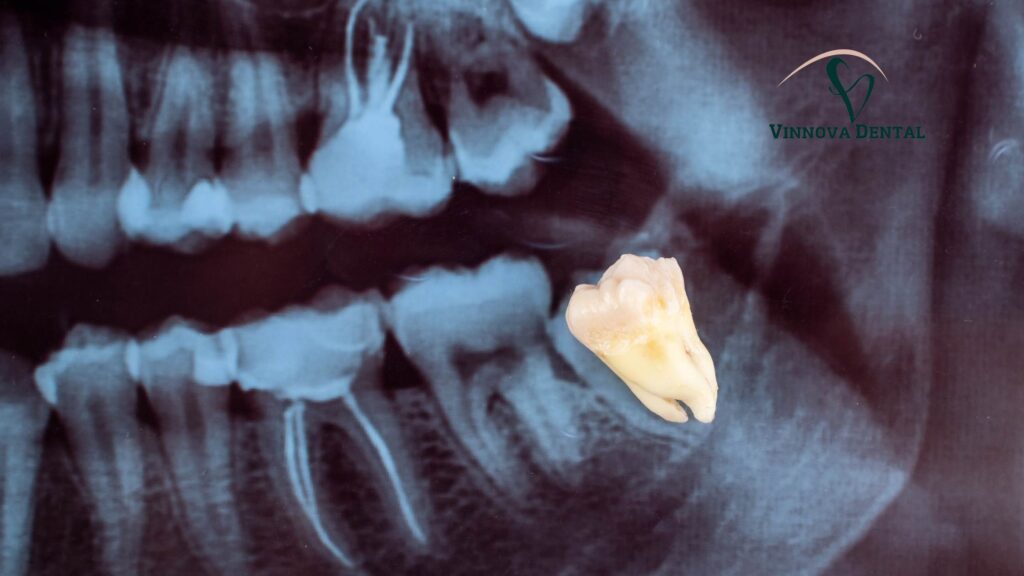 Symptoms Of Tooth Extraction