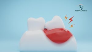 Swollen Gums