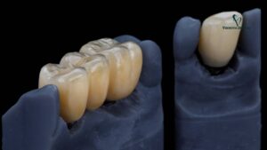 Porcelain vs. Metal Crowns: Pros, Cons & Which One to Choose