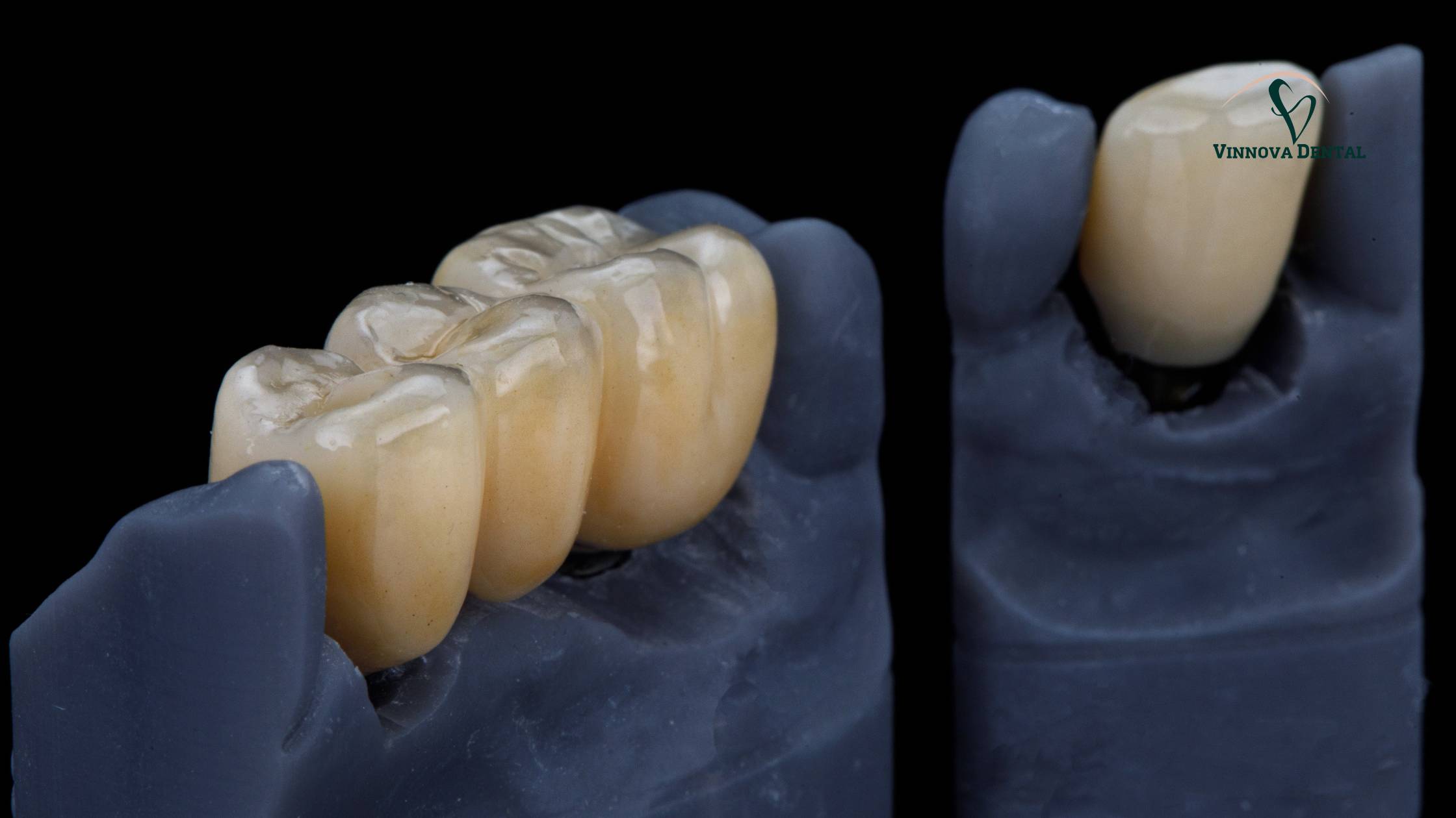 Porcelain vs. Metal Crowns: Pros, Cons & Which One to Choose
