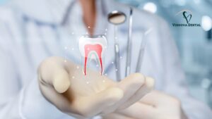 Root Canal