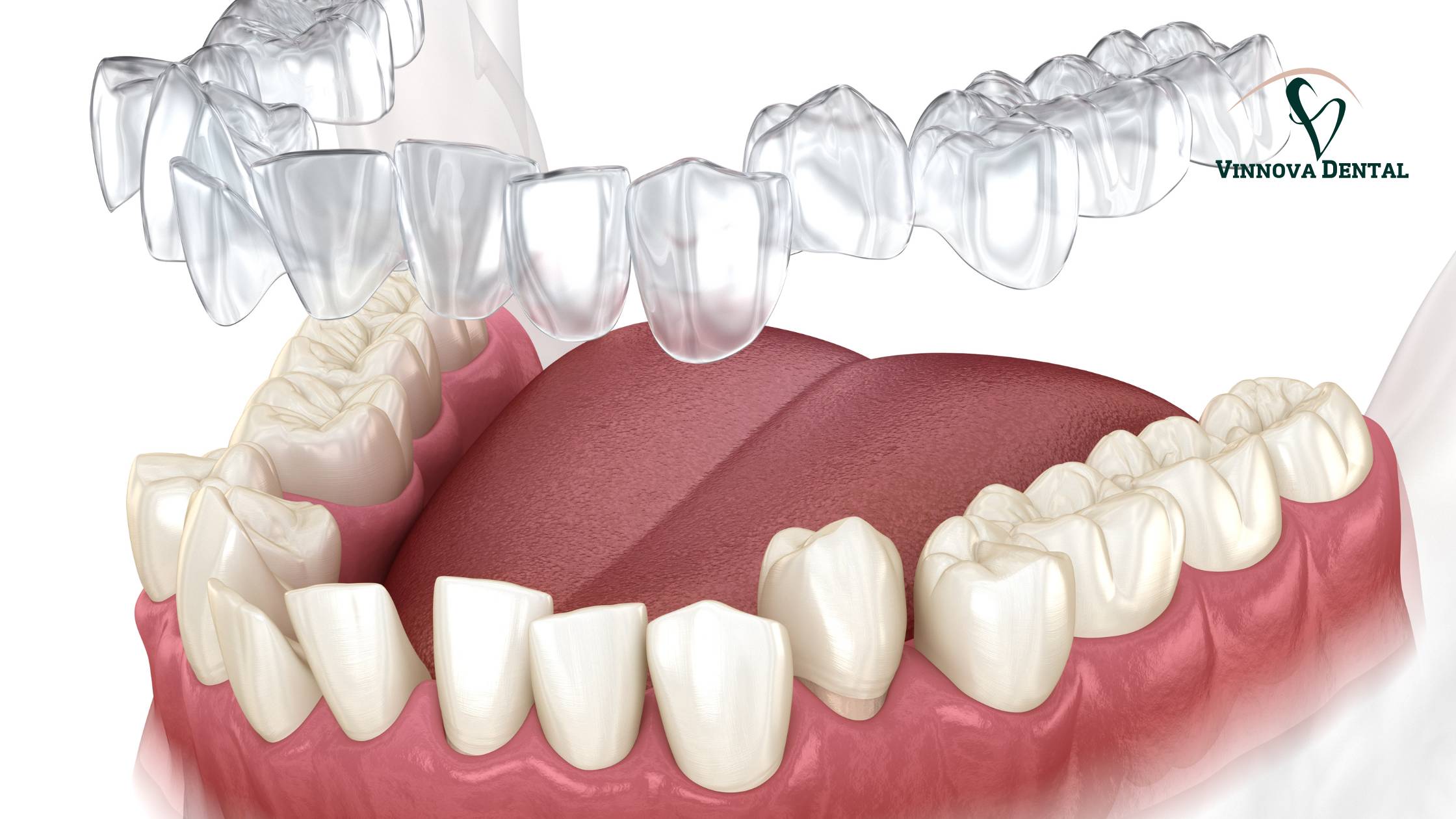 What to Expect on Your First Invisalign Appointment at Vinnova Dental