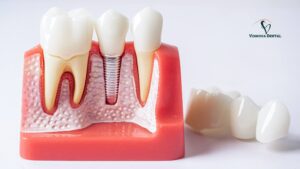 Implants Teeth
