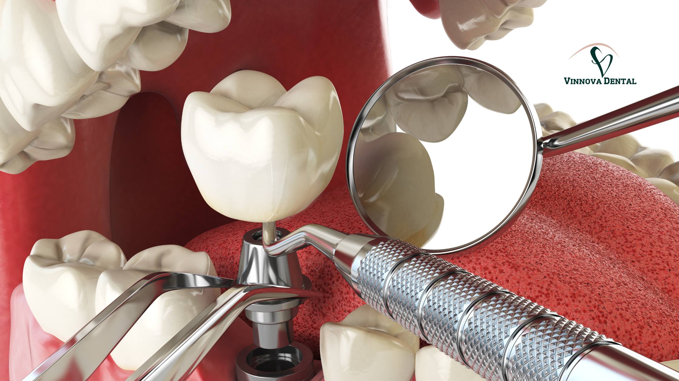 Dental Implants