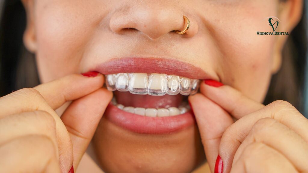 Invisalign Before and After: Real Results from Vinnova Dental Patients Invisalign