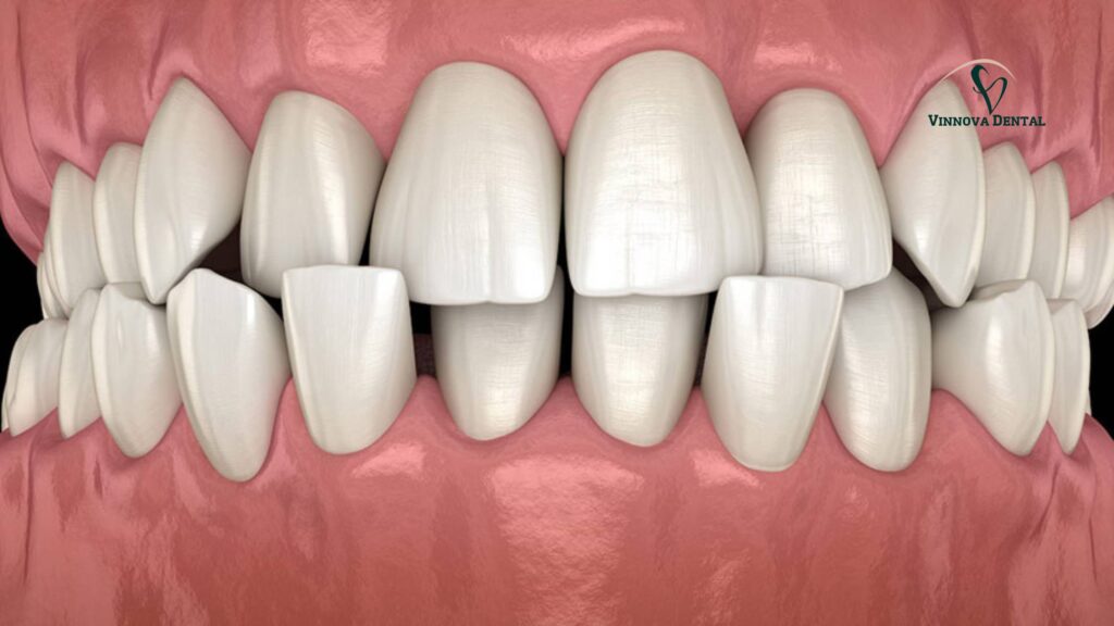 Invisalign Before and After with Crossbite, Overbite & Underbite Cases Bite Issues