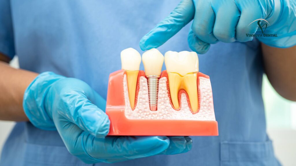 Dental Implants