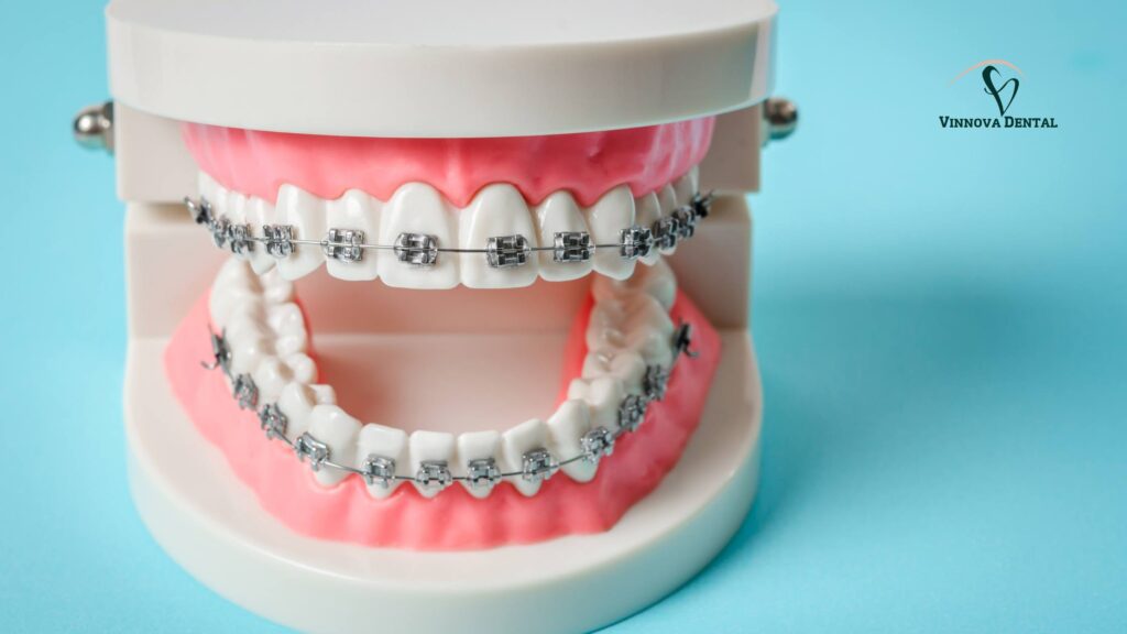 Invisalign Before and After: Real Results from Vinnova Dental Patients Traditional