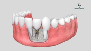 Implant Bone Graft