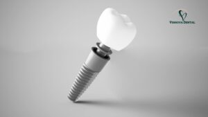 Implant Crown