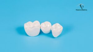 Implant Crown