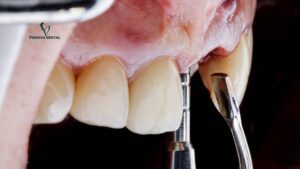 Implant Bone Graft