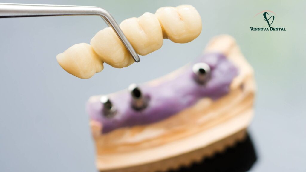Caring for Your Implant Bridge: Dental Hygiene Tips That Work Implant Bridge