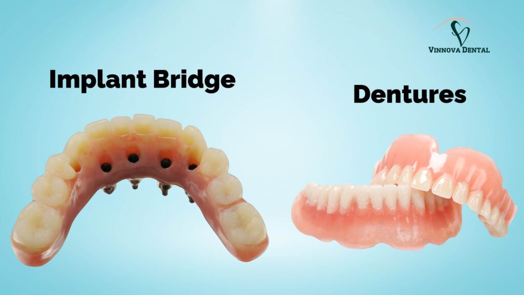 Implant Bridge vs. Dentures: Which Is Right for You in 2025? Implant Bridge