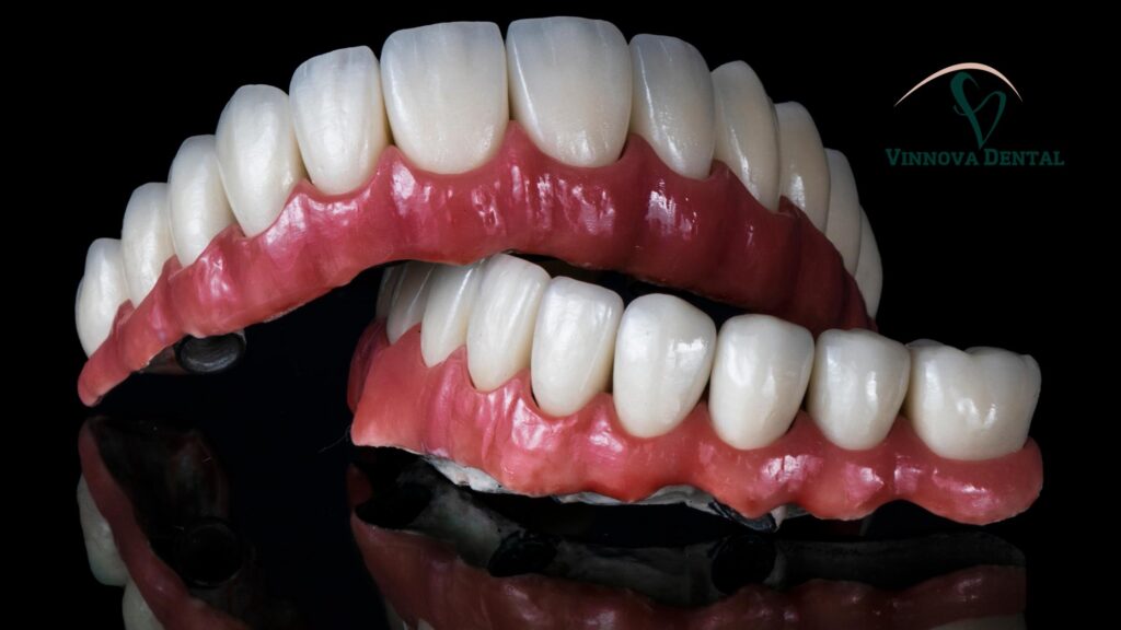 Implant Bridge in Albury & Wodonga: Why Patients Trust Vinnova Dental implant bridge