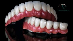 implant bridge