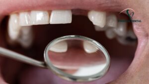 Missing Teeth