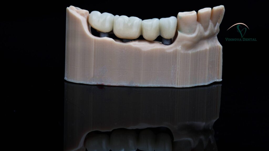 Caring for Your Implant Bridge: Dental Hygiene Tips That Work Implant Bridge
