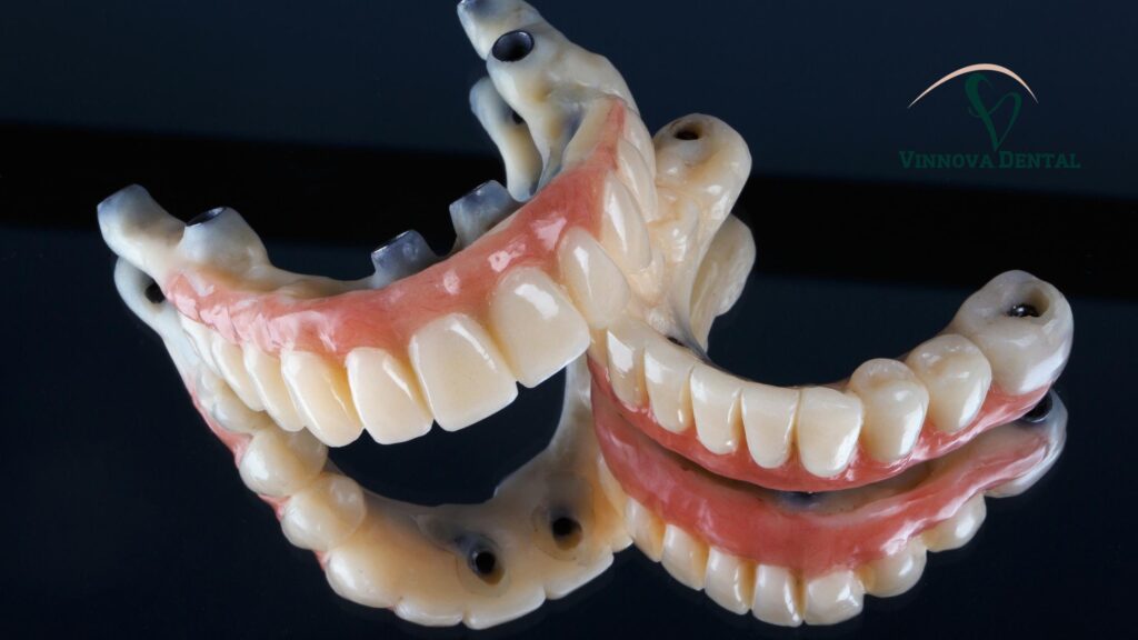 Implant Bridge in Albury & Wodonga: Why Patients Trust Vinnova Dental implant bridge