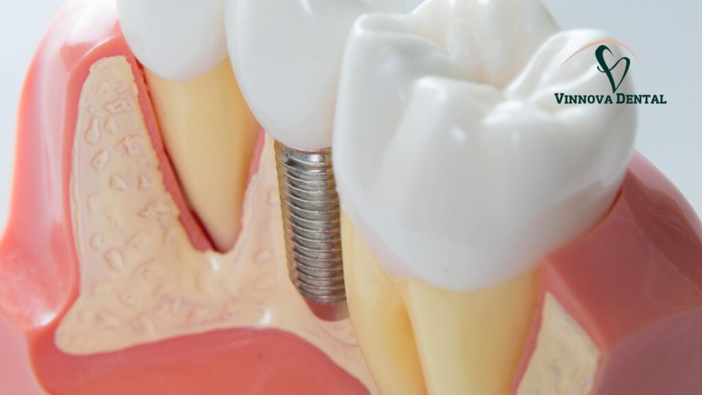 Single Tooth vs. Implant Bridge: Best Choice for Missing Teeth Single Tooth vs. Implant Bridge: Best Choice for Missing Teeth