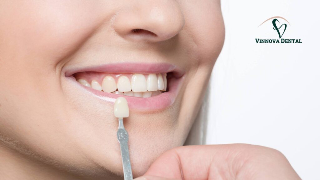 Veneers Cost Per Tooth: Porcelain vs Composite Breakdown Veneers Cost Per Tooth