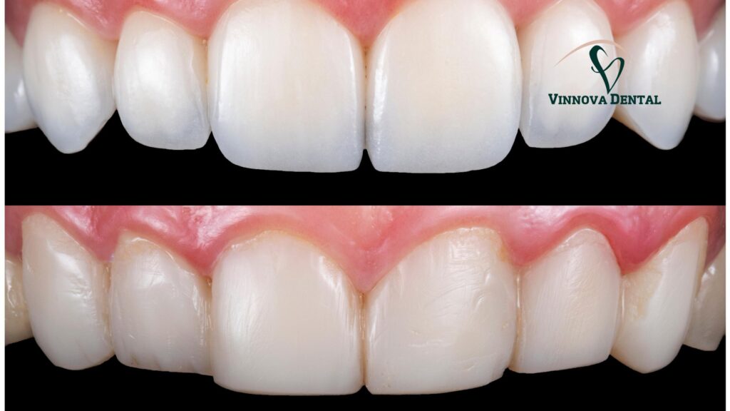 Top Mistakes in Veneers Before and After Results (And How to Avoid Them) Veneers Before and After