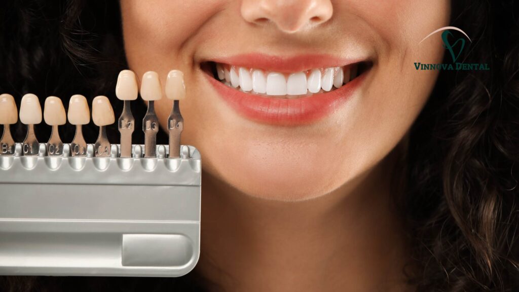 Cheap Veneers Cost Dangers: Why Low Prices Can Backfire Dental veneers
