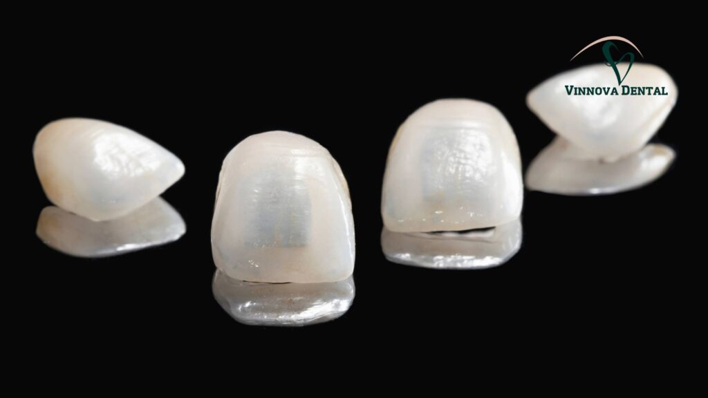 Veneers Cost Per Tooth: Porcelain vs Composite Breakdown Veneers Cost Per Tooth: Porcelain vs Composite Breakdown