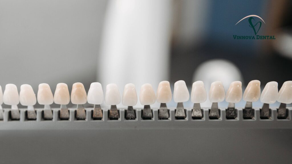 Veneers Cost Per Tooth: Porcelain vs Composite Breakdown Porcelain Veneers