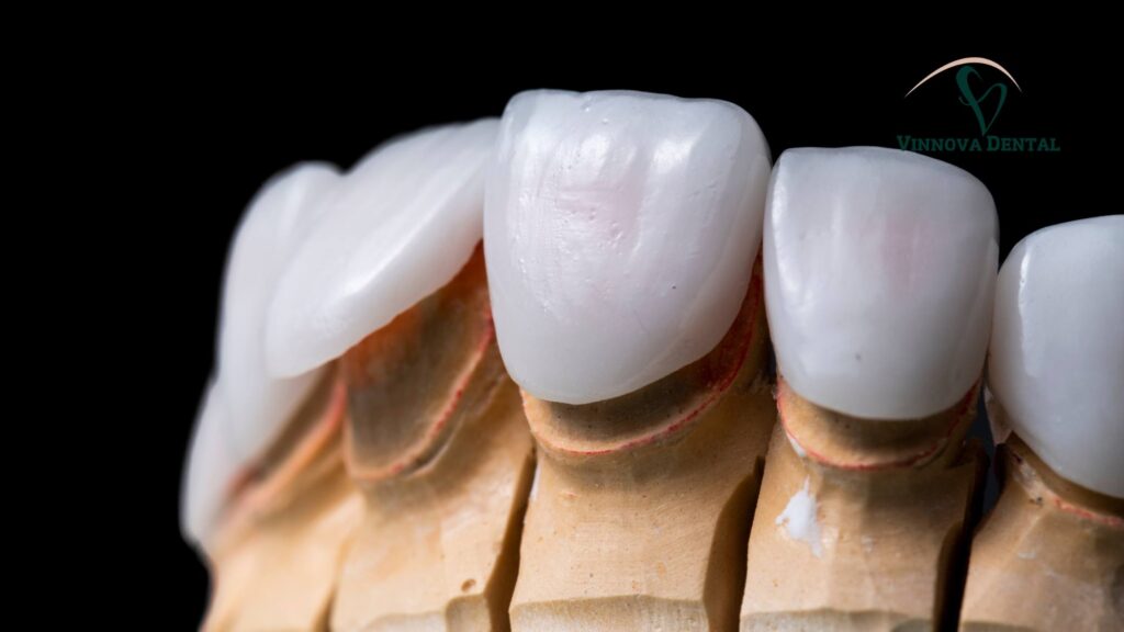 Veneers Cost Per Tooth: Porcelain vs Composite Breakdown Composite Veneers