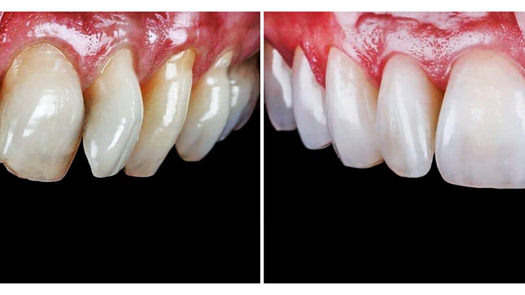 Veneers Cost Per Tooth: Porcelain vs Composite Breakdown Veneers Before and After