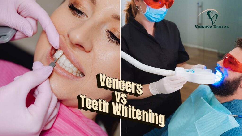 Veneers vs Teeth Whitening