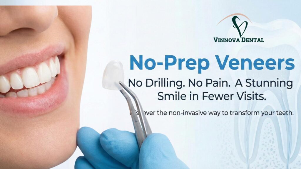 No-Prep Veneers
