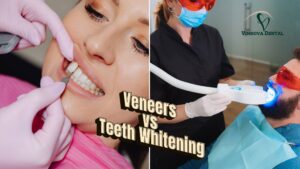 Veneers vs Teeth Whitening