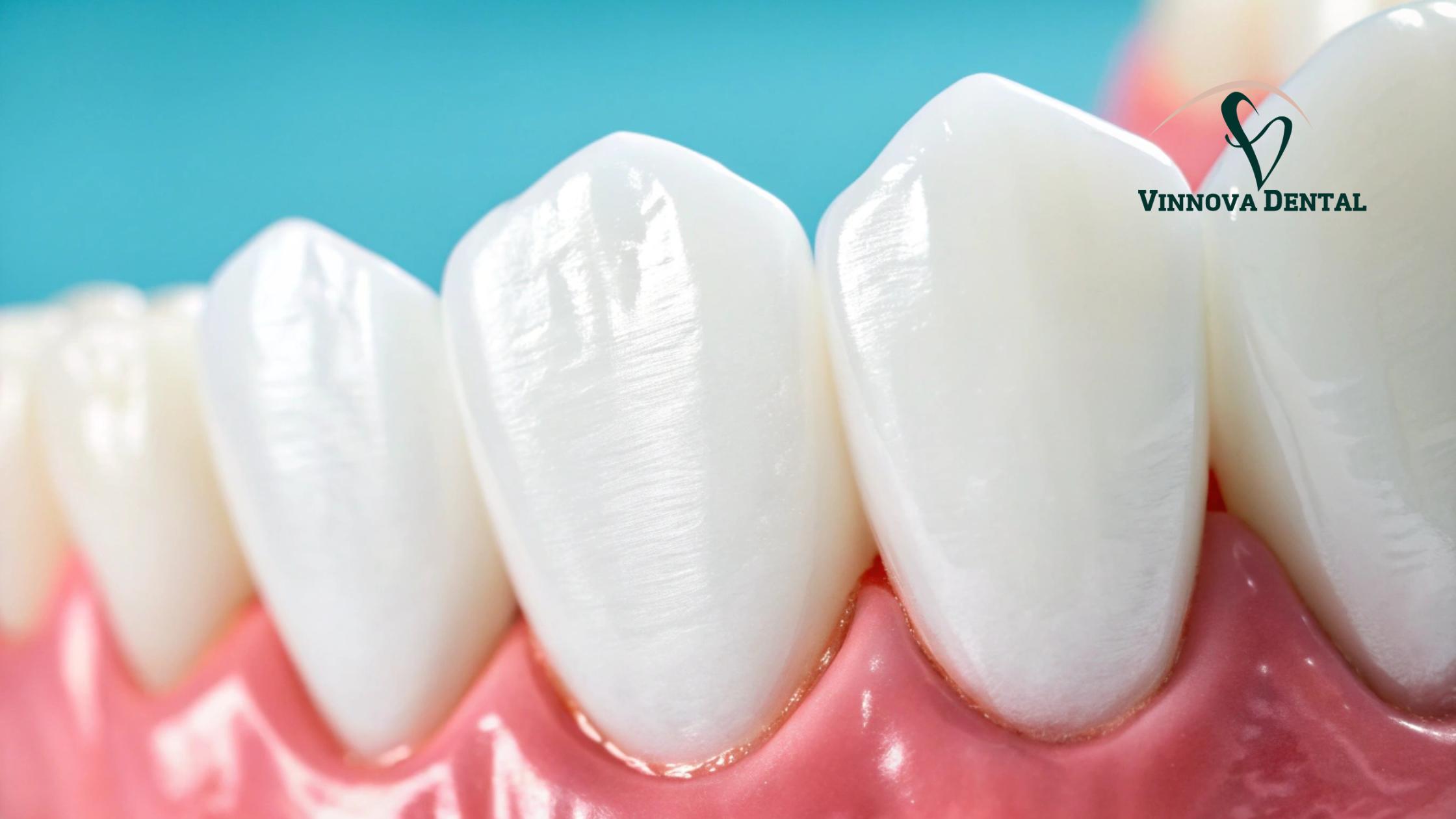 Veneers Teeth