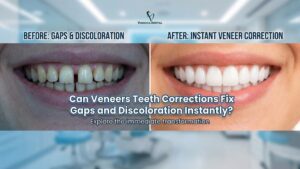 Veneers